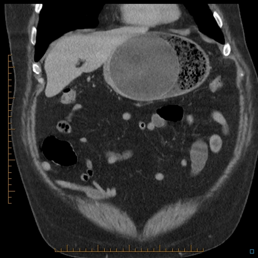 File:Bariatric balloon causing gastric outlet obstruction (Radiopaedia 54449-60672 B 14).jpg