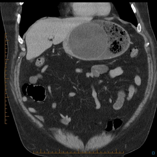 File:Bariatric balloon causing gastric outlet obstruction (Radiopaedia 54449-60672 B 16).jpg