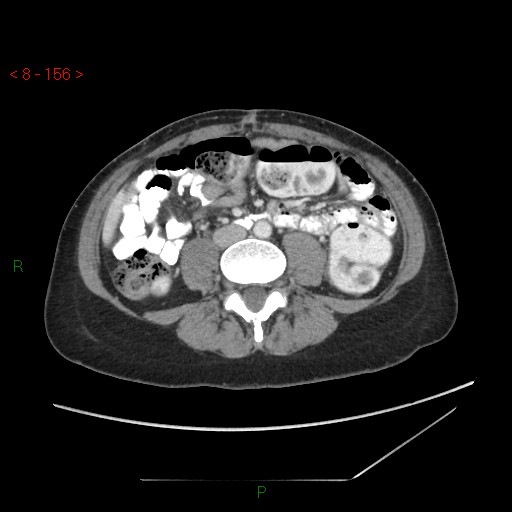 Bartholin gland cyst (Radiopaedia 54904-61181 A 39).jpg