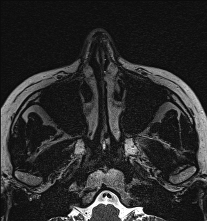 Basal cell carcinoma - nasal region (Radiopaedia 70292-80365 Axial Gradient Echo 14).jpg