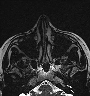 Basal cell carcinoma - nasal region (Radiopaedia 70292-80365 Axial Gradient Echo 28).jpg