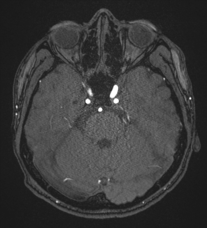 Basal ganglia subacute infarct (Radiopaedia 80201-93521 Axial MRA 32).png