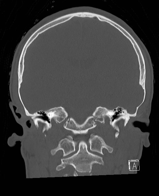 Base of skull fracture with bilateral Le Fort fractures (Radiopaedia 47094-51638 Coronal bone window 45).jpg