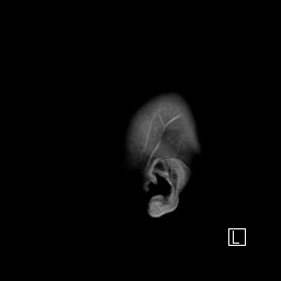 Base of skull rhabdomyosarcoma (Radiopaedia 32196-33142 J 5).jpg