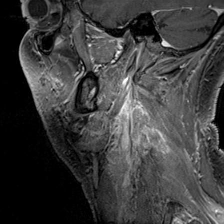 Base of tongue squamous cell carcinoma (Radiopaedia 31174-31884 F 40).jpg