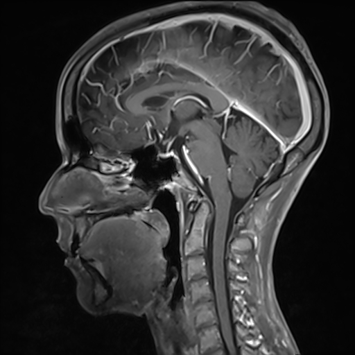 File:Basilar artery perforator aneurysm (Radiopaedia 82455-97733 G 75).jpg