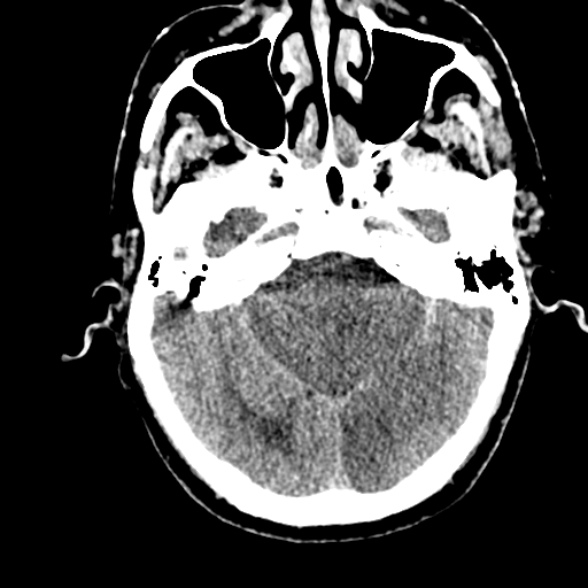 Basilar artery thrombosis (Radiopaedia 53351-59352 Axial non-contrast 40).jpg