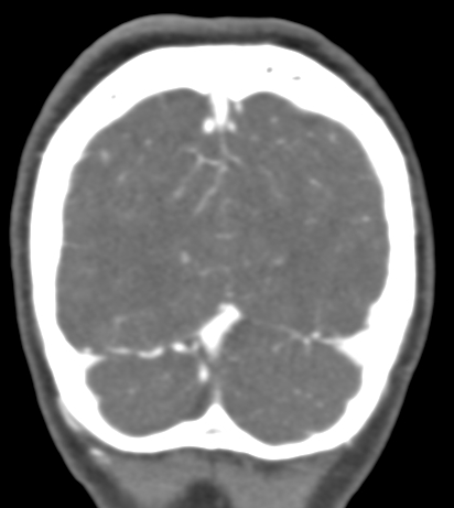Basilar tip aneurysm with coiling (Radiopaedia 53912-60086 B 139).jpg