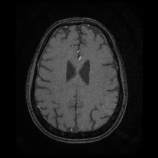 Basilar top and left middle cerebral artery aneurysm (Radiopaedia 61965-70031 Axial MRA 118).jpg