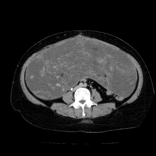 Benign spindle cell tumor - abdominopelvic (Radiopaedia 61300-69212 Axial C+ delayed 37).jpg