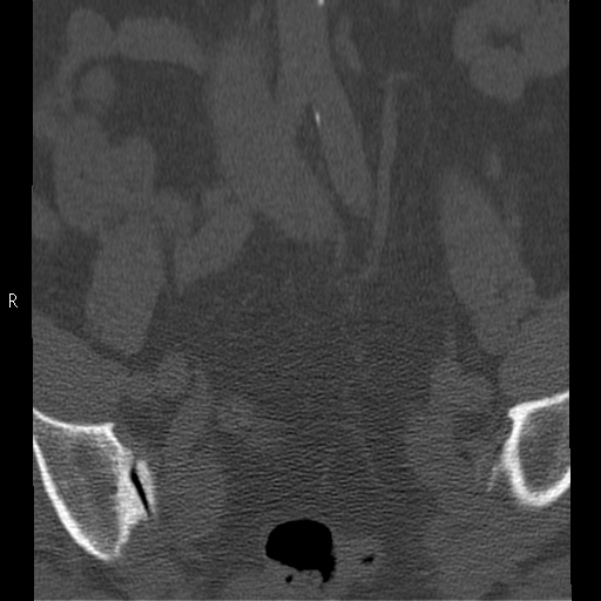 Bertolotti syndrome (Radiopaedia 24864-25128 Coronal bone window 3).jpg