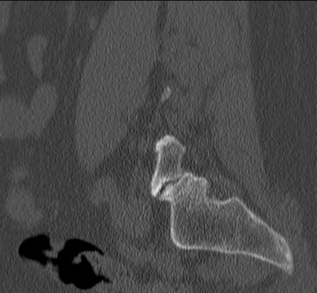 Bertolotti syndrome (Radiopaedia 24864-25128 Sagittal bone window 45).jpg