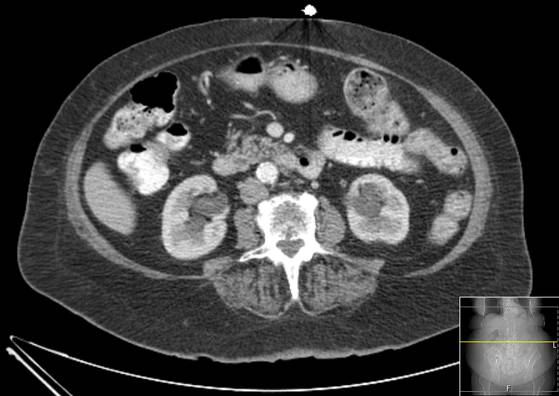 File:Bicameral celiacomesenteric aneurysm (Radiopaedia 55766-62327 A 31).jpg