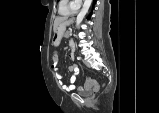 Bicameral celiacomesenteric aneurysm (Radiopaedia 55766-62327 B 34).jpg