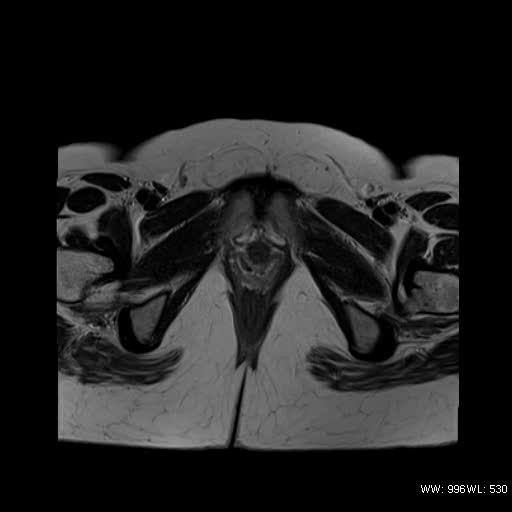 File:Bicornuate uterus- on MRI (Radiopaedia 49206-54297 Axial T2 17).jpg