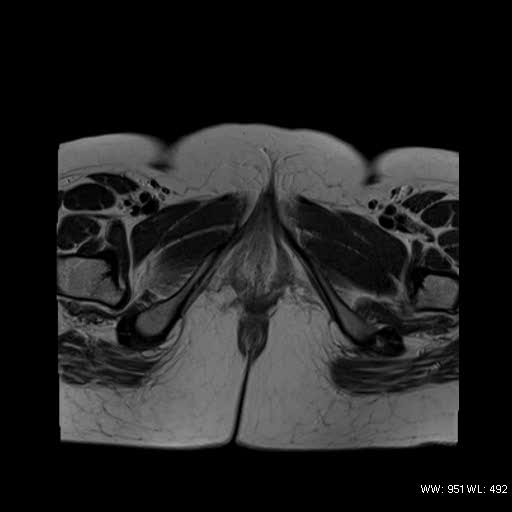 File:Bicornuate uterus- on MRI (Radiopaedia 49206-54297 Axial T2 19).jpg