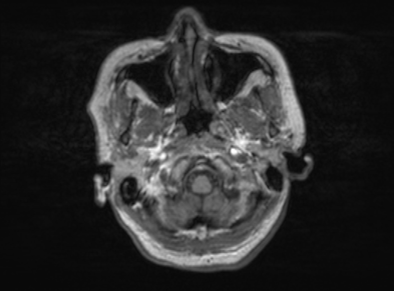 Bilateral PCA territory infarction - different ages (Radiopaedia 46200-51784 Axial T1 344).jpg