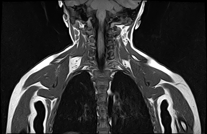 File:Bilateral Sprengel deformity with Klippel-Feil syndrome (Radiopaedia 66395-75650 Coronal T1 15).jpg