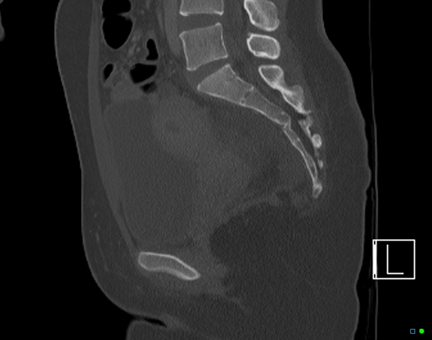 Bilateral acetabular fractures (Radiopaedia 79272-92308 Sagittal bone window 48).jpg
