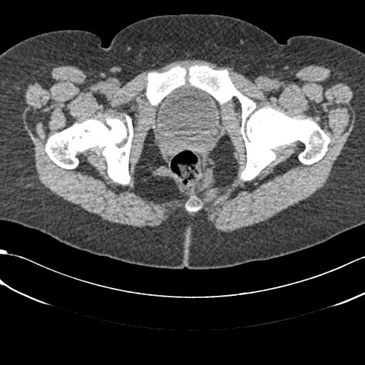 Bilateral acetabular protrusion with pincer type femoro-acetabular impingement (Radiopaedia 30134-30733 AXIAL SOFT THIN 62).jpg