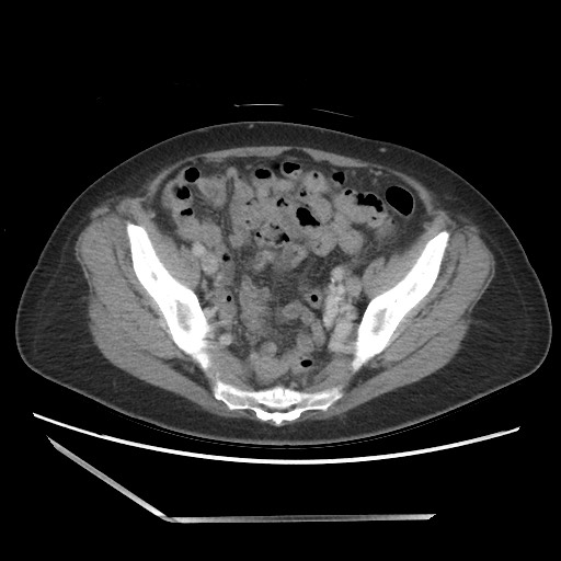 Bilateral adrenal granulocytic sarcomas (chloromas) (Radiopaedia 78375-91007 A 95).jpg