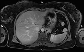 Bilateral adrenal myelolipoma (Radiopaedia 63058-71537 H 24).jpg