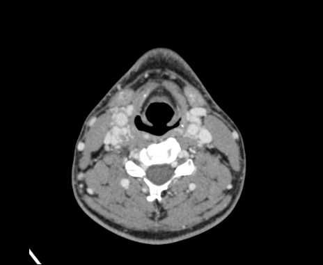 Bilateral carotid body tumors (Radiopaedia 61841-69870 Axial Post contrast 62).jpg