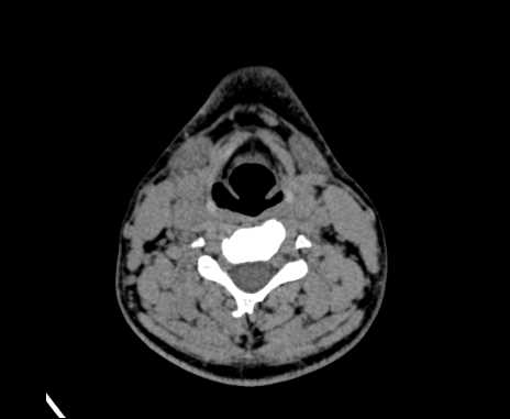 Bilateral carotid body tumors (Radiopaedia 61841-69870 Axial non-contrast 61).jpg