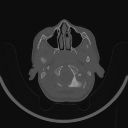 Bilateral otosclerosis (Radiopaedia 57237-64157 C 7).jpg