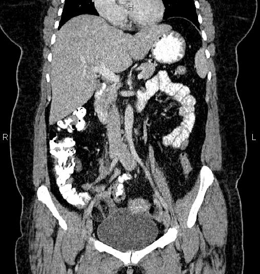 File:Bilateral ovarian dermoid cysts (Radiopaedia 85785-101603 C 23).jpg