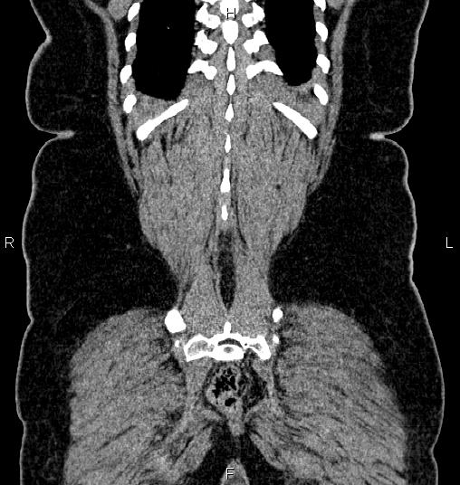 Bilateral ovarian dermoid cysts (Radiopaedia 85785-101603 C 55).jpg