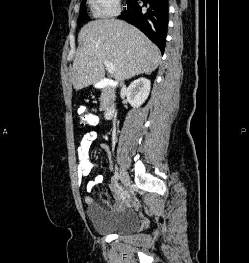 Bilateral ovarian dermoid cysts (Radiopaedia 85785-101603 D 33).jpg