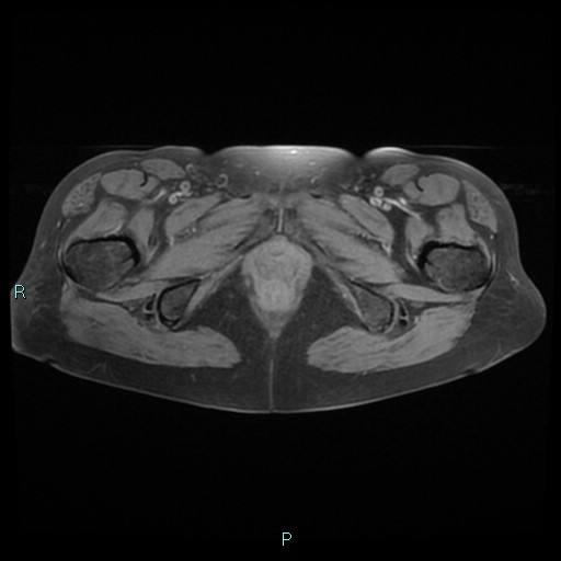 File:Bilateral ovarian fibroma (Radiopaedia 44568-48293 Axial T1 fat sat 28).jpg