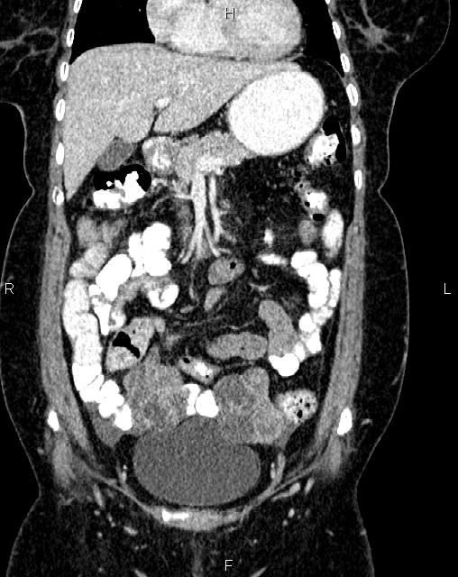 Bilateral ovarian serous cystadenocarcinoma (Radiopaedia 86062-101989 D 11).jpg