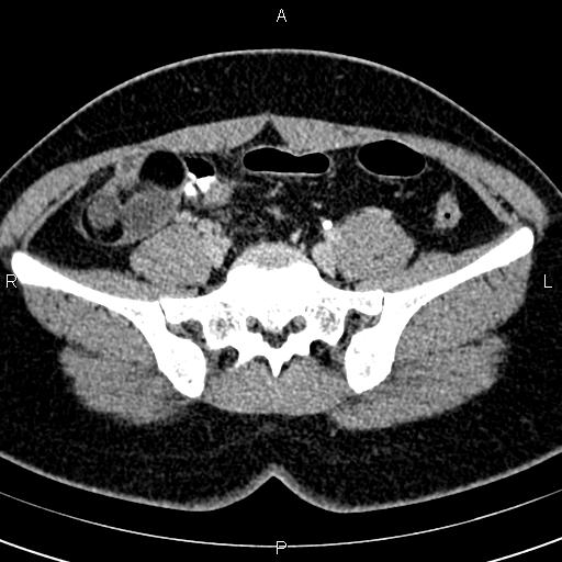 Bilateral ovarian teratoma (Radiopaedia 83131-97503 B 19).jpg