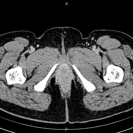 File:Bilateral ovarian teratoma (Radiopaedia 83131-97503 B 90).jpg