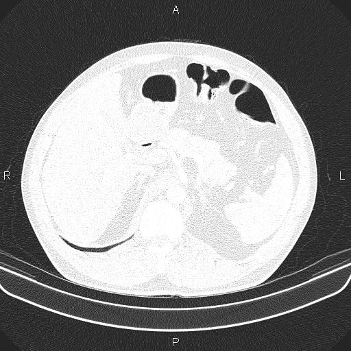 File:Bilateral pulmonary AVM (Radiopaedia 83134-97505 Axial lung window 76).jpg