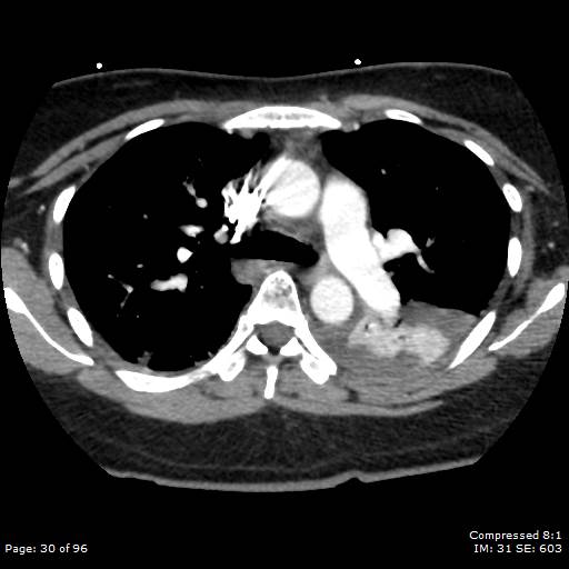 Bilateral pulmonary emboli with Hampton hump sign (Radiopaedia 54070-60246 Axial C+ CTPA 27).jpg