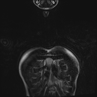 Bilateral spinoglenoid notch ganglion cysts (Radiopaedia 29577-30082 Coronal T2 3).jpg