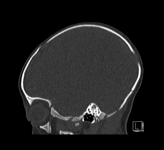 Bilateral subdural hemorrhage and parietal skull fracture (Radiopaedia 26058-26192 Sagittal bone window 24).png