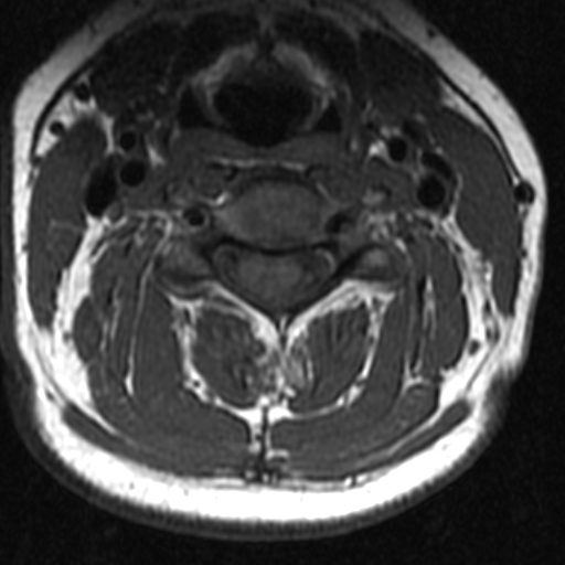 File:Bilateral tortuous vertebral arteries (Radiopaedia 19070-19039 Axial T2 13).jpg