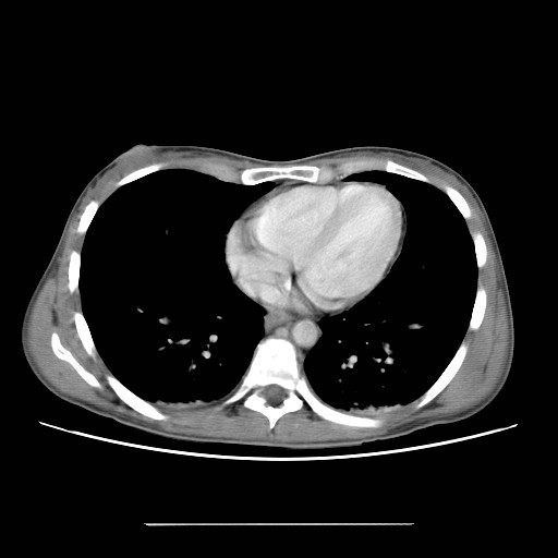 File:Bilateral tubo-ovarian abscess (Radiopaedia 20359).jpg