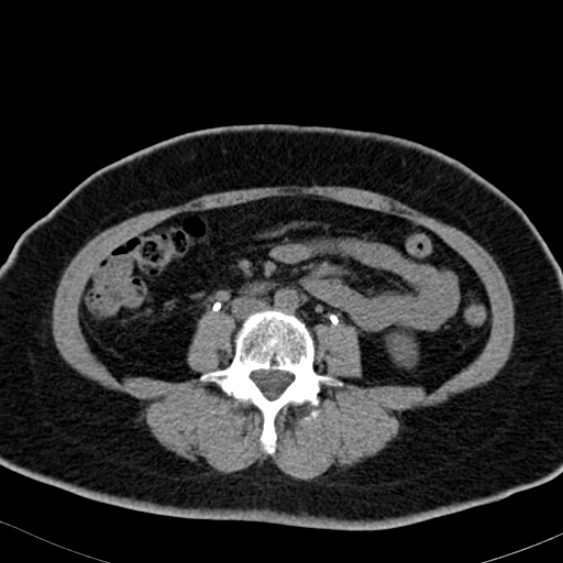 File:Bilateral ureteric stents (Radiopaedia 48795-53825 Axial non-contrast 33).jpg