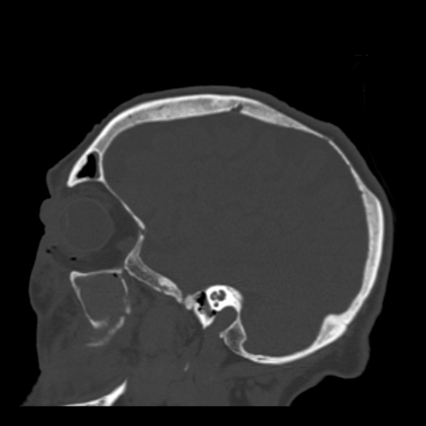 Biparietal osteodystrophy (Radiopaedia 46109-50463 Sagittal bone window 78).jpg