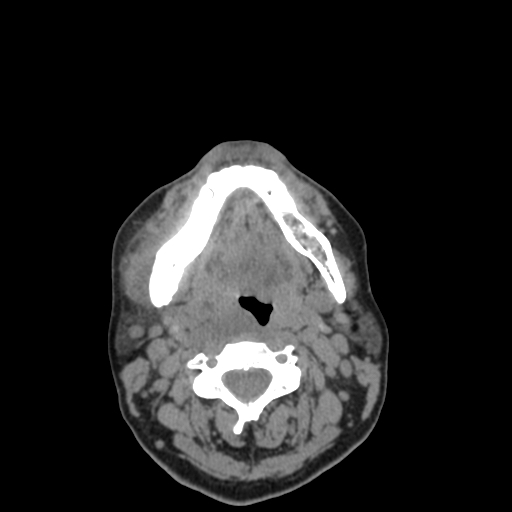 Bisphosphonate-related osteonecrosis of the jaw (Radiopaedia 71324-81642 non-contrast 55).jpg