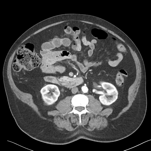 File:Bladder papillary urothelial carcinoma (Radiopaedia 48119-52951 A 25).png