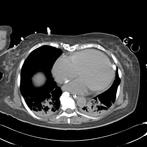 File:Bladder rupture post renal biopsy (Radiopaedia 30863-31572 Axial non-contrast 4).jpg