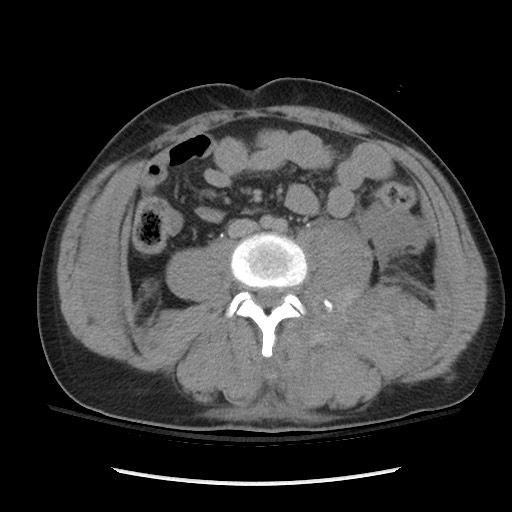 Blunt abdominal trauma with solid organ and musculoskelatal injury with active extravasation (Radiopaedia 68364-77895 Axial C+ delayed 82).jpg