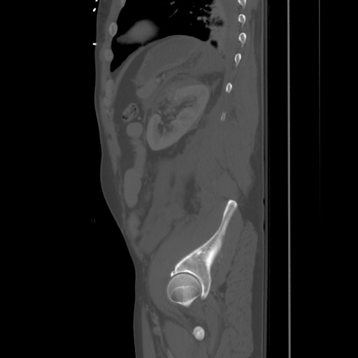 Blunt abdominal trauma with solid organ and musculoskelatal injury with active extravasation (Radiopaedia 68364-77895 Sagittal bone window 82).jpg
