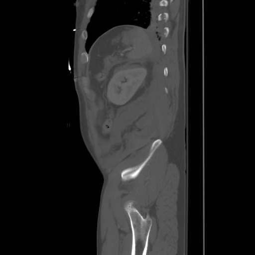 Blunt abdominal trauma with solid organ and musculoskelatal injury with active extravasation (Radiopaedia 68364-77895 Sagittal bone window 92).jpg